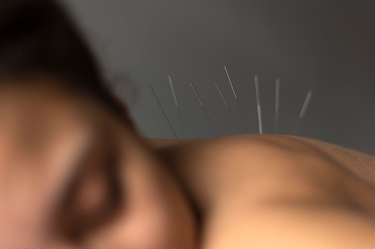 This picture portrays a female patient receiving acupuncture.