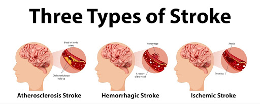 types of stroke