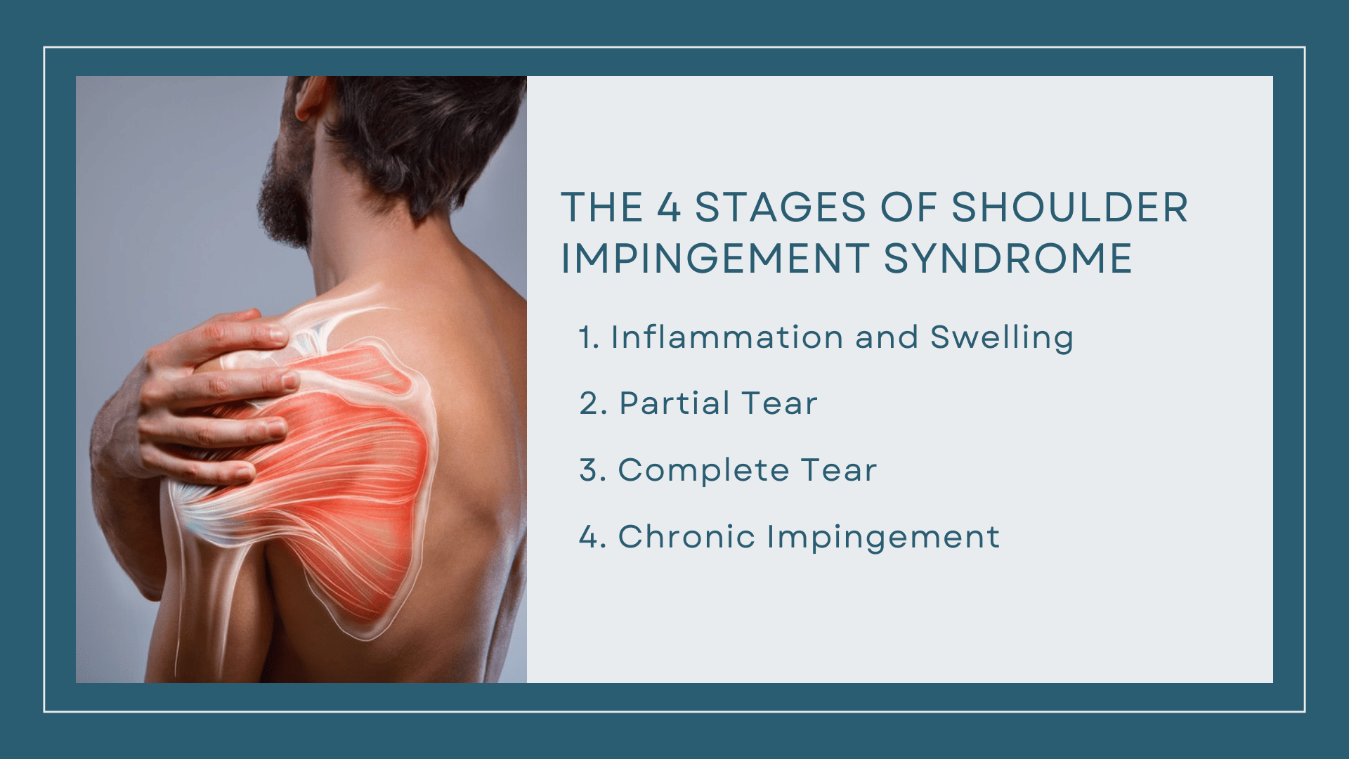 This infographic details the 4 stages of shoulder impingement syndrome