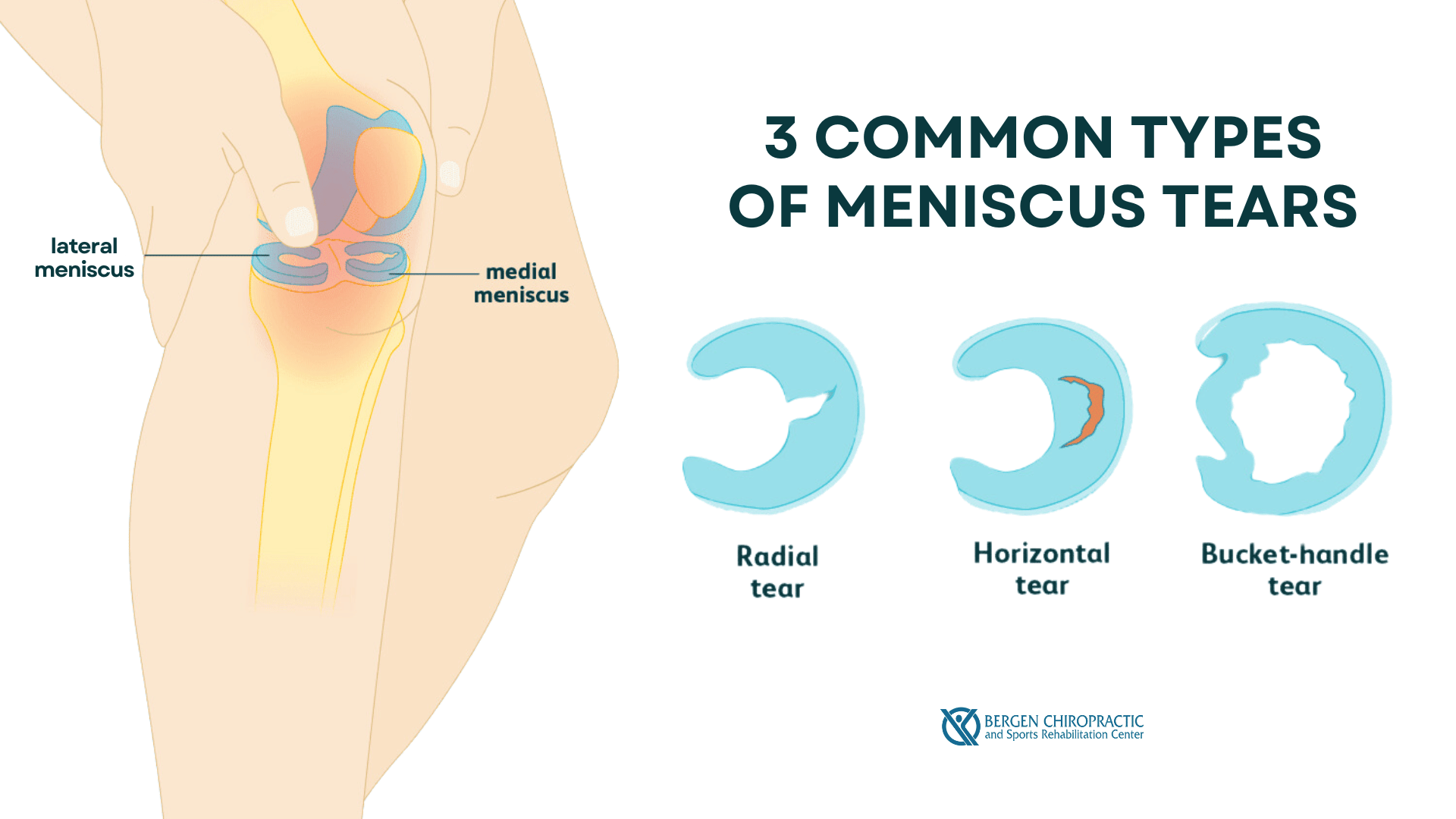 This infographic details 3 common types of meniscus tears