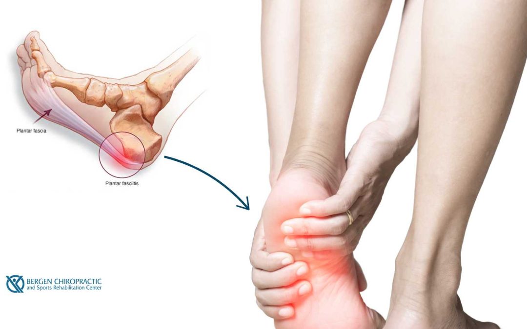 Chronic vs. Acute Plantar Fasciitis: Tailoring Chiropractic Care for Your Condition