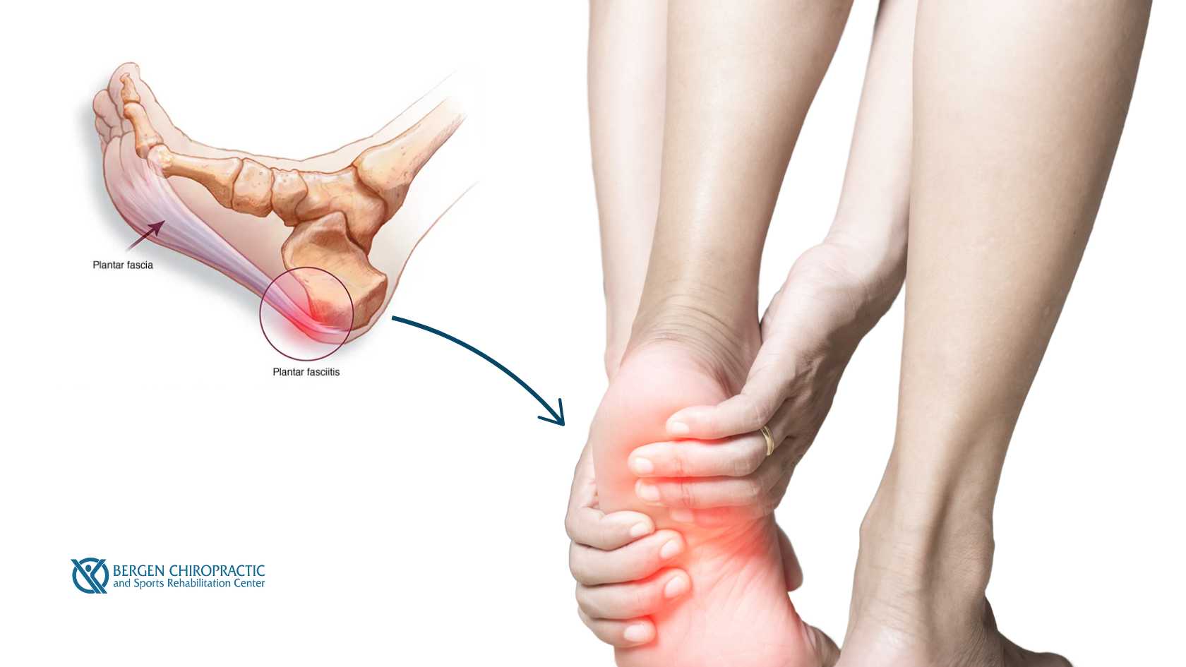 Chronic vs. Acute Plantar Fasciitis: Tailoring Chiropractic Care for Your Condition