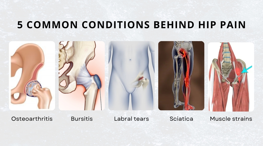 5 common conditions behind hip pain